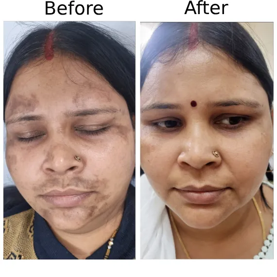 Skin Rejuvenation Treatment