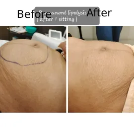 Skin Treatment