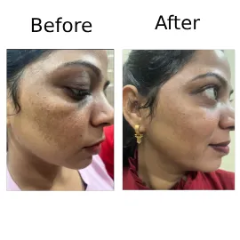 Skin Treatment