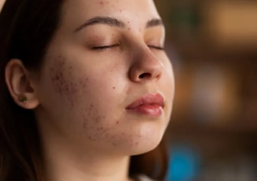 Acne Treatment