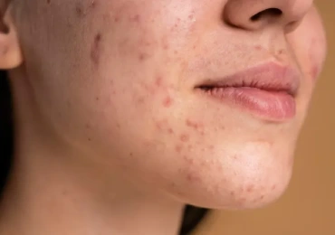 Pigmentation Treatment